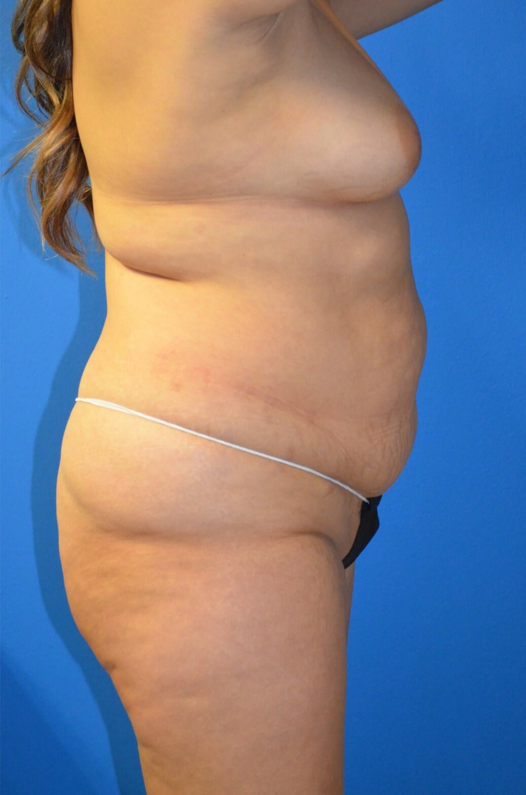 Lipoabdominoplasty and Lipo360 Before
