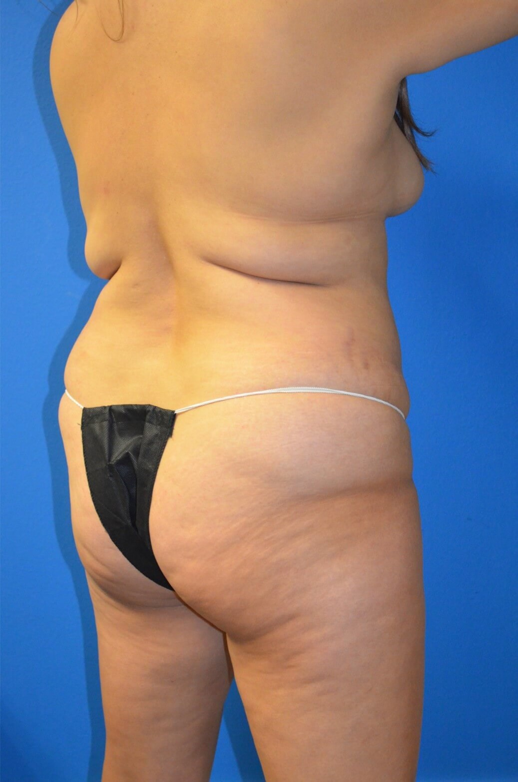 Lipoabdominoplasty and Lipo360 Before