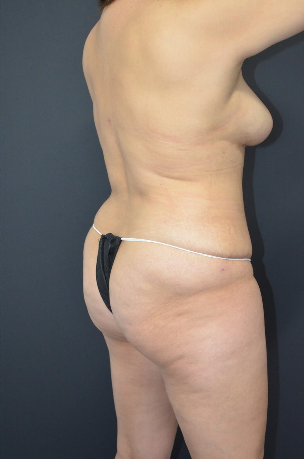 Lipoabdominoplasty and Lipo360 After