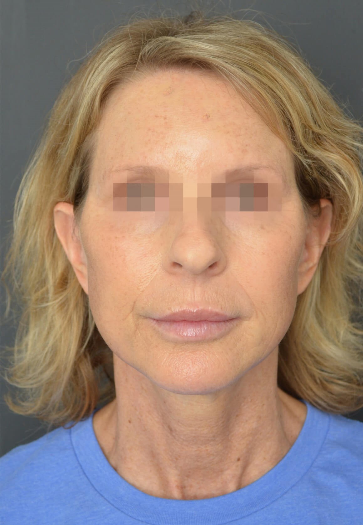 Deep plane face and necklift After