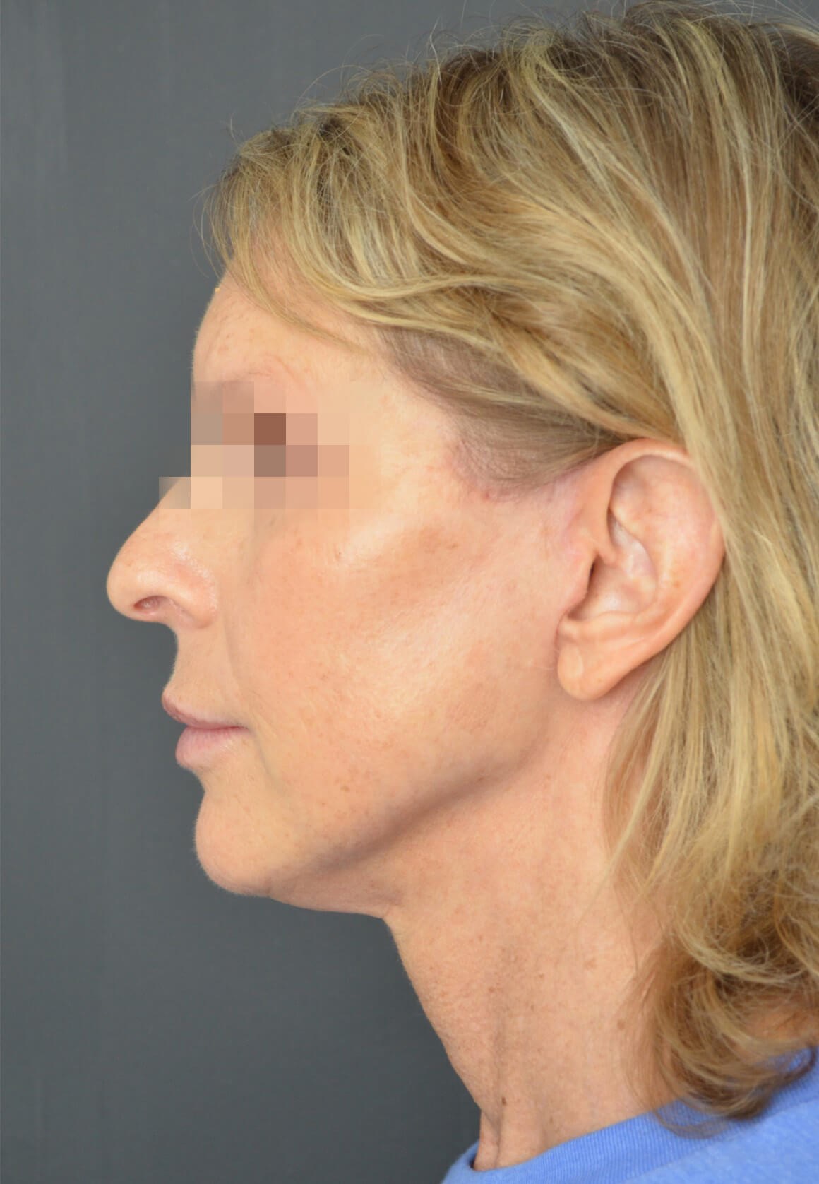 Deep plane face and necklift After