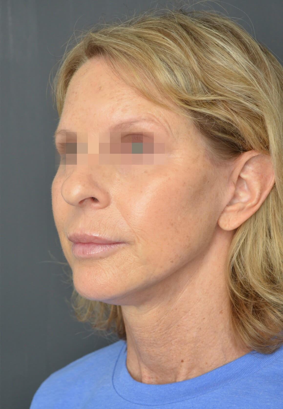 Deep plane face and necklift After