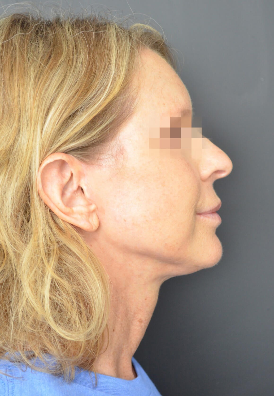 Deep plane face and necklift After