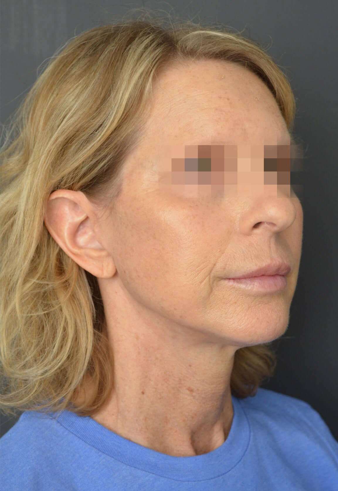 Deep plane face and necklift After