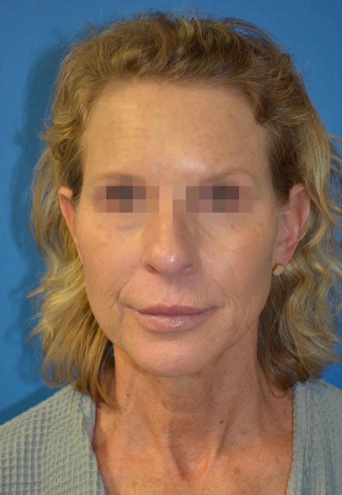 Deep plane face and necklift Before