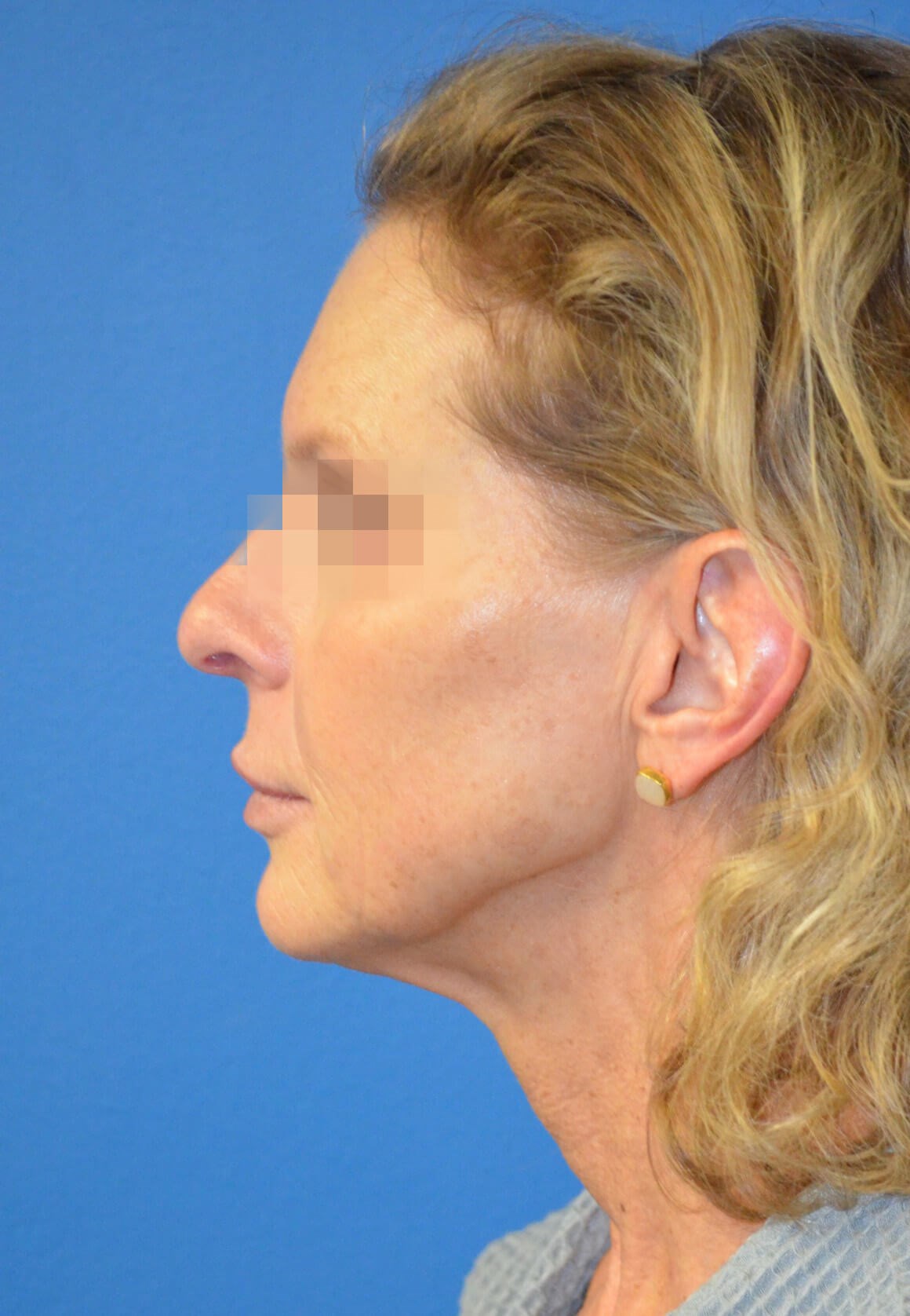 Deep plane face and necklift Before