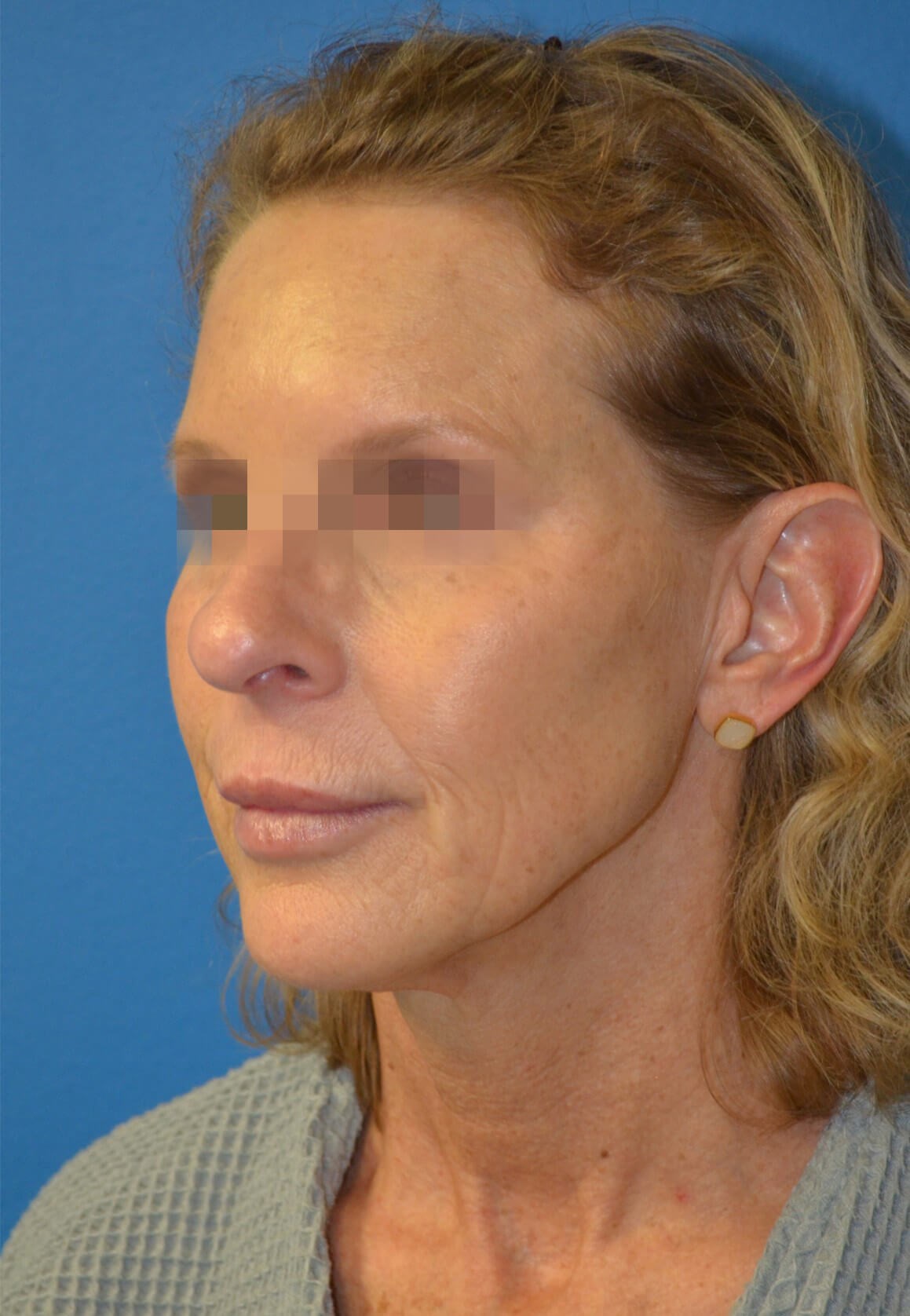 Deep plane face and necklift Before