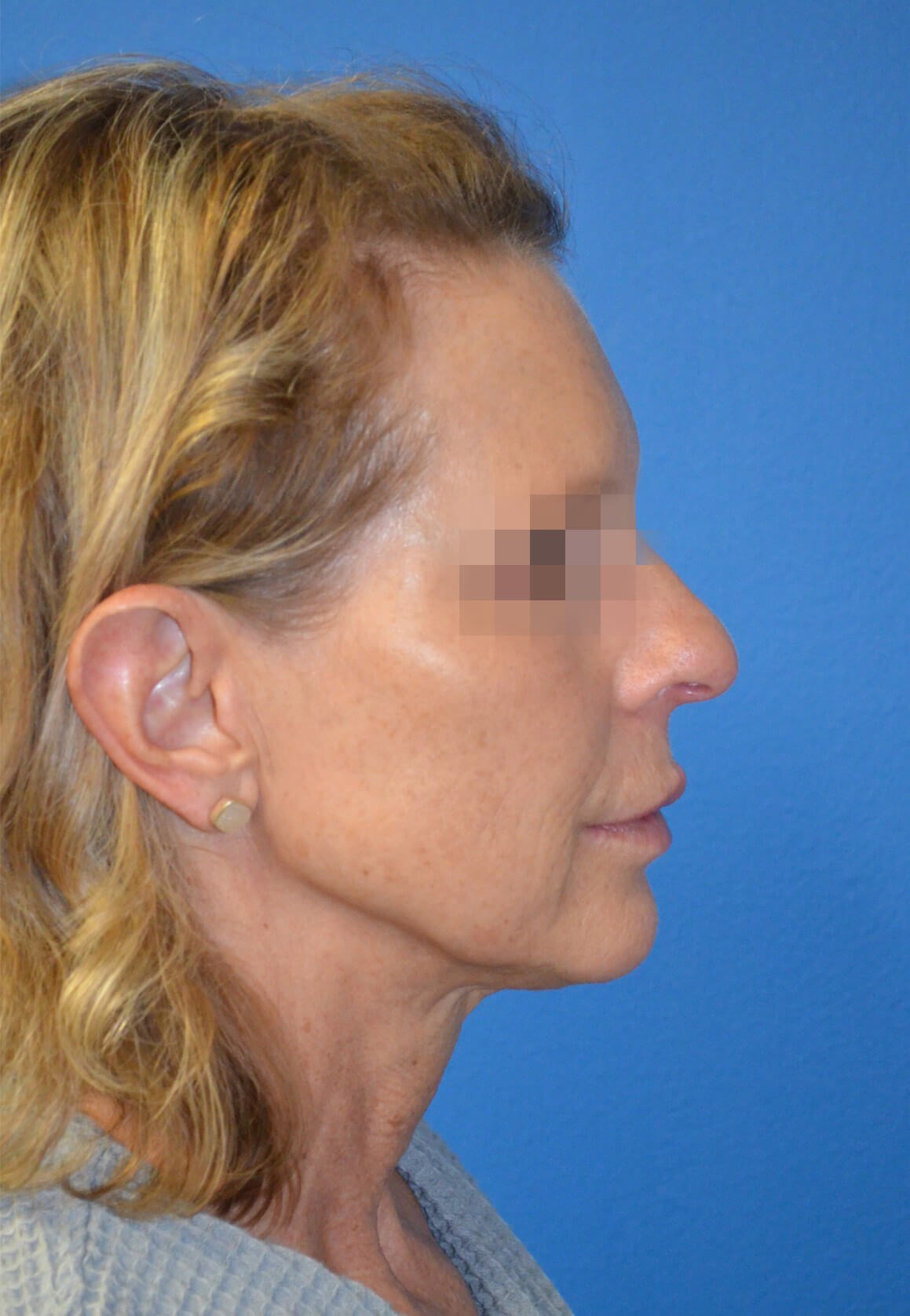 Deep plane face and necklift Before