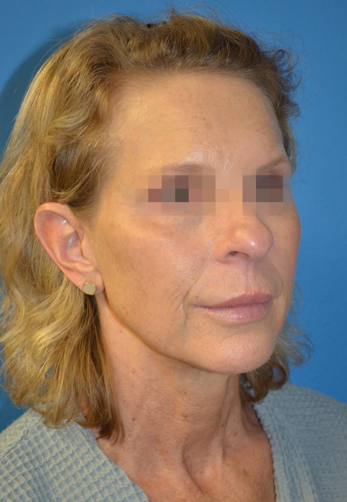 Deep plane face and necklift Before
