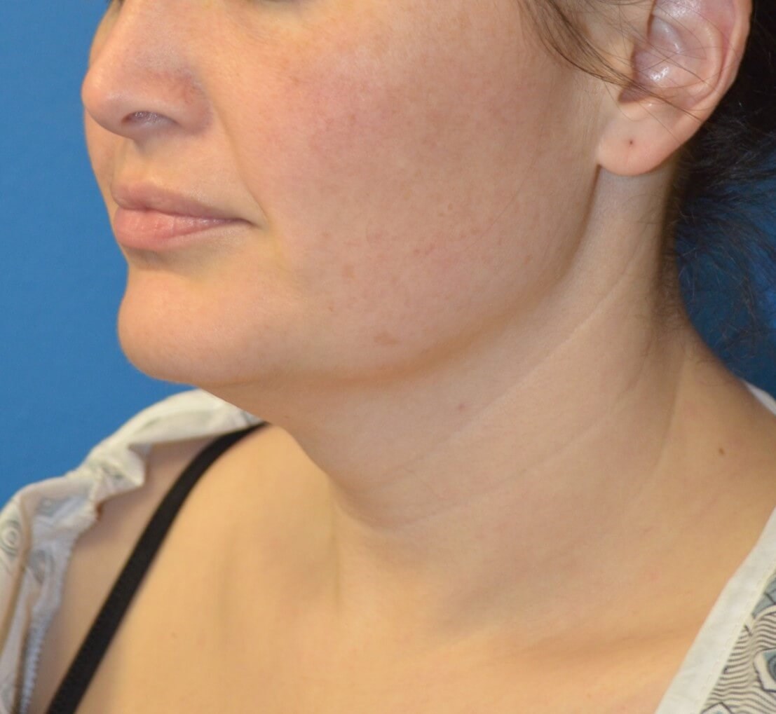 Deep Necklift (Submental) Before