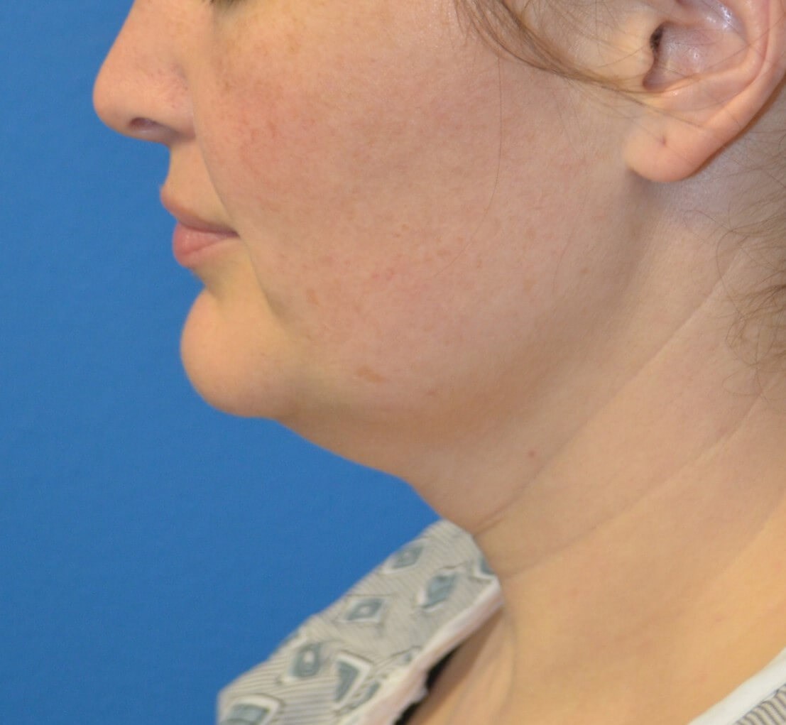 Deep Necklift (Submental) Before