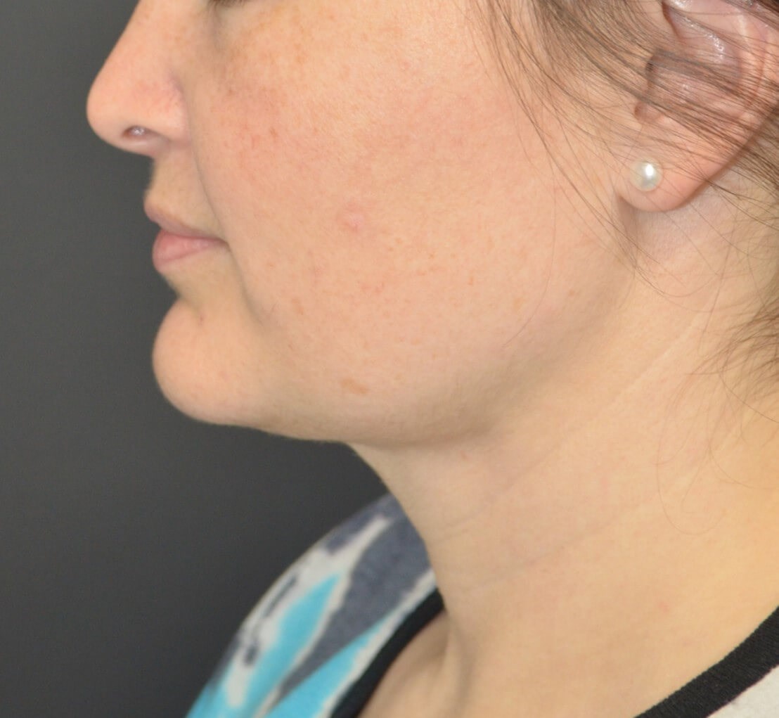 Deep Necklift (Submental) After