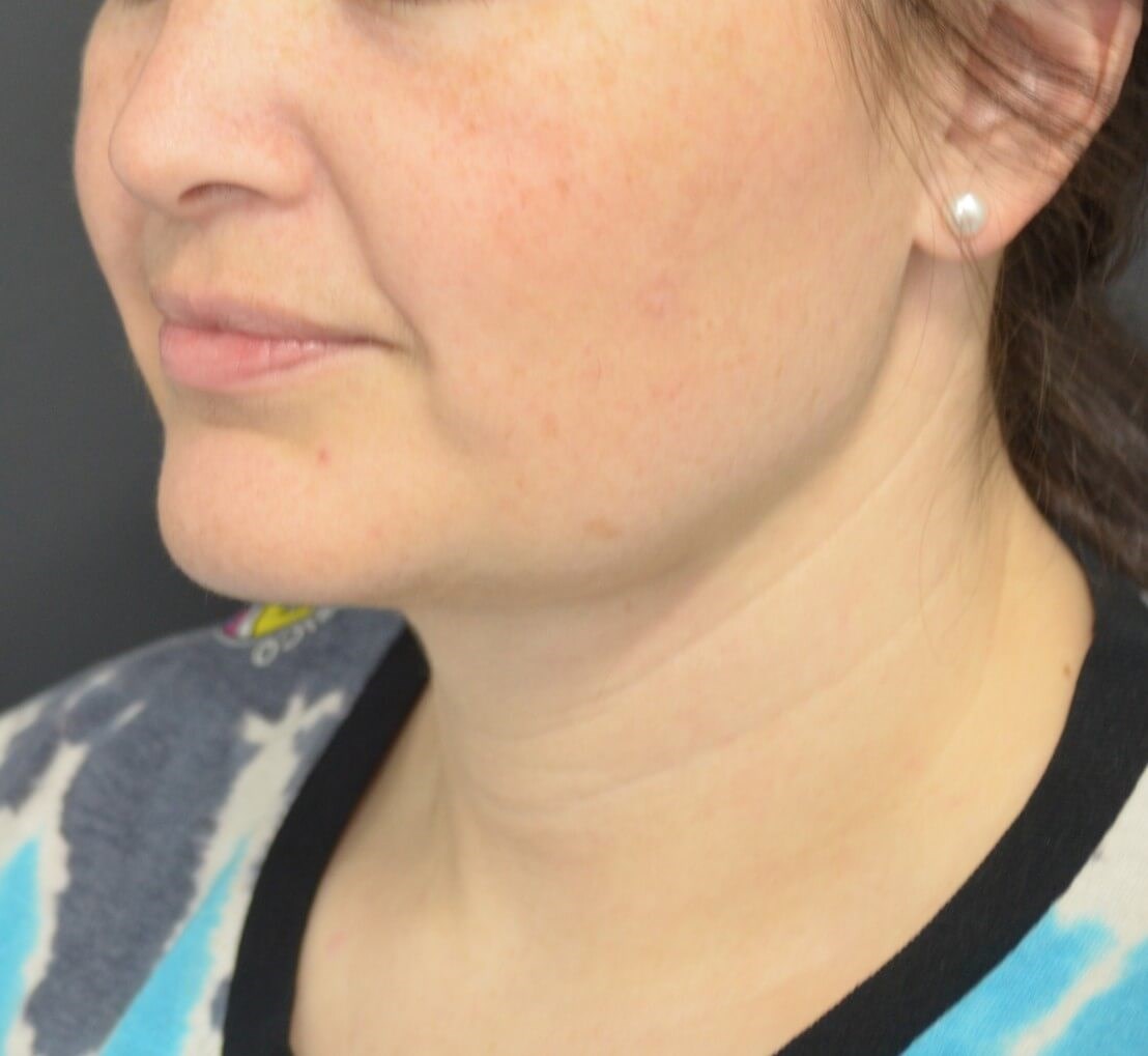 Deep Necklift (Submental) After