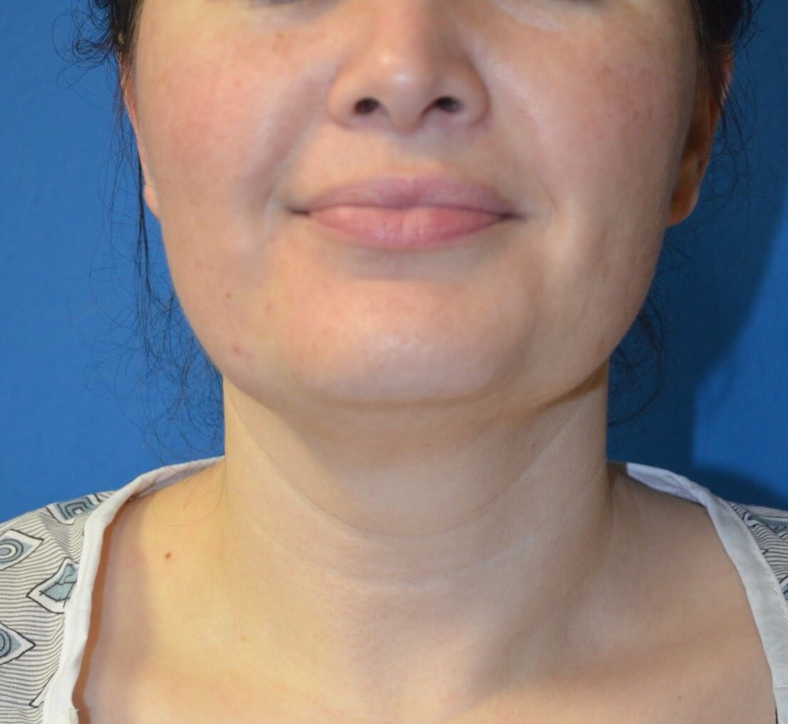 Deep Necklift (Submental) Before