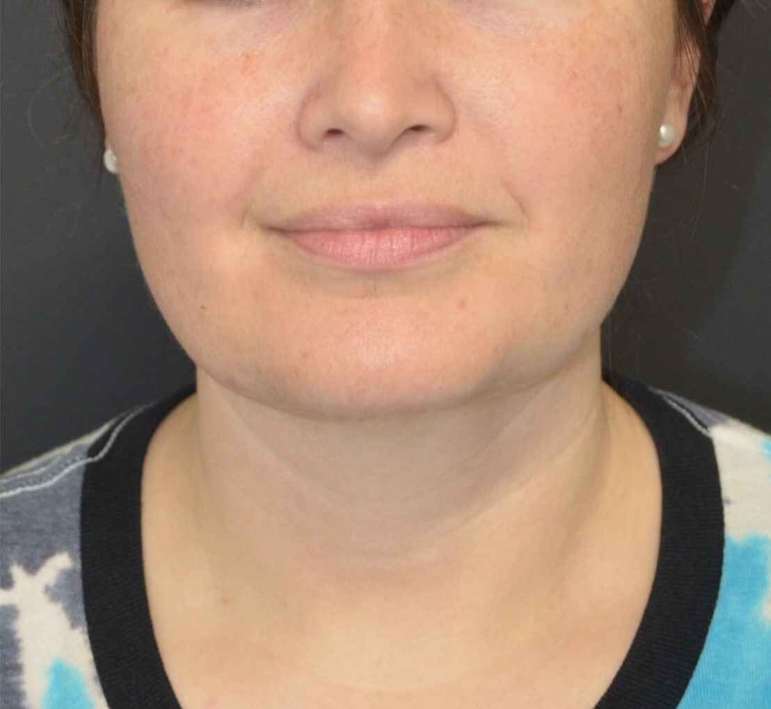 Deep Necklift (Submental) After