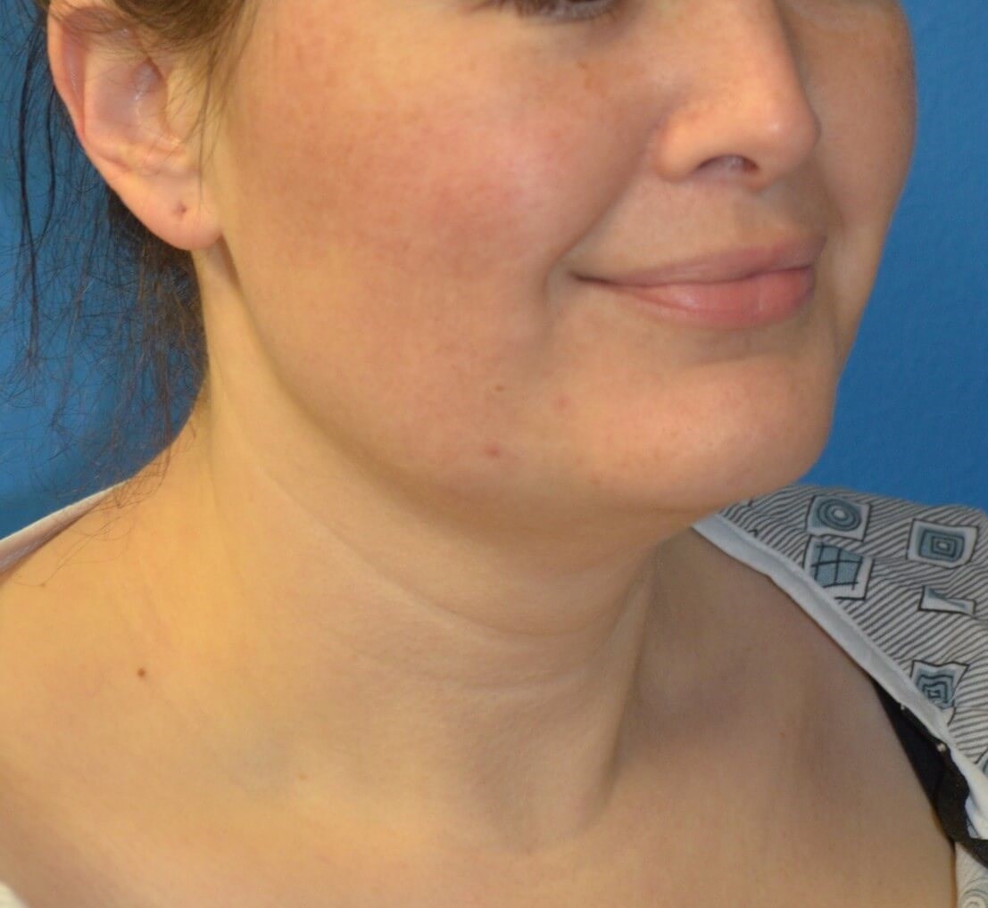 Deep Necklift (Submental) Before