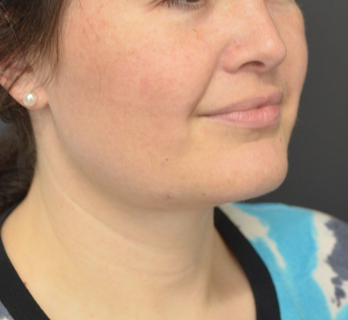 Deep Necklift (Submental) After