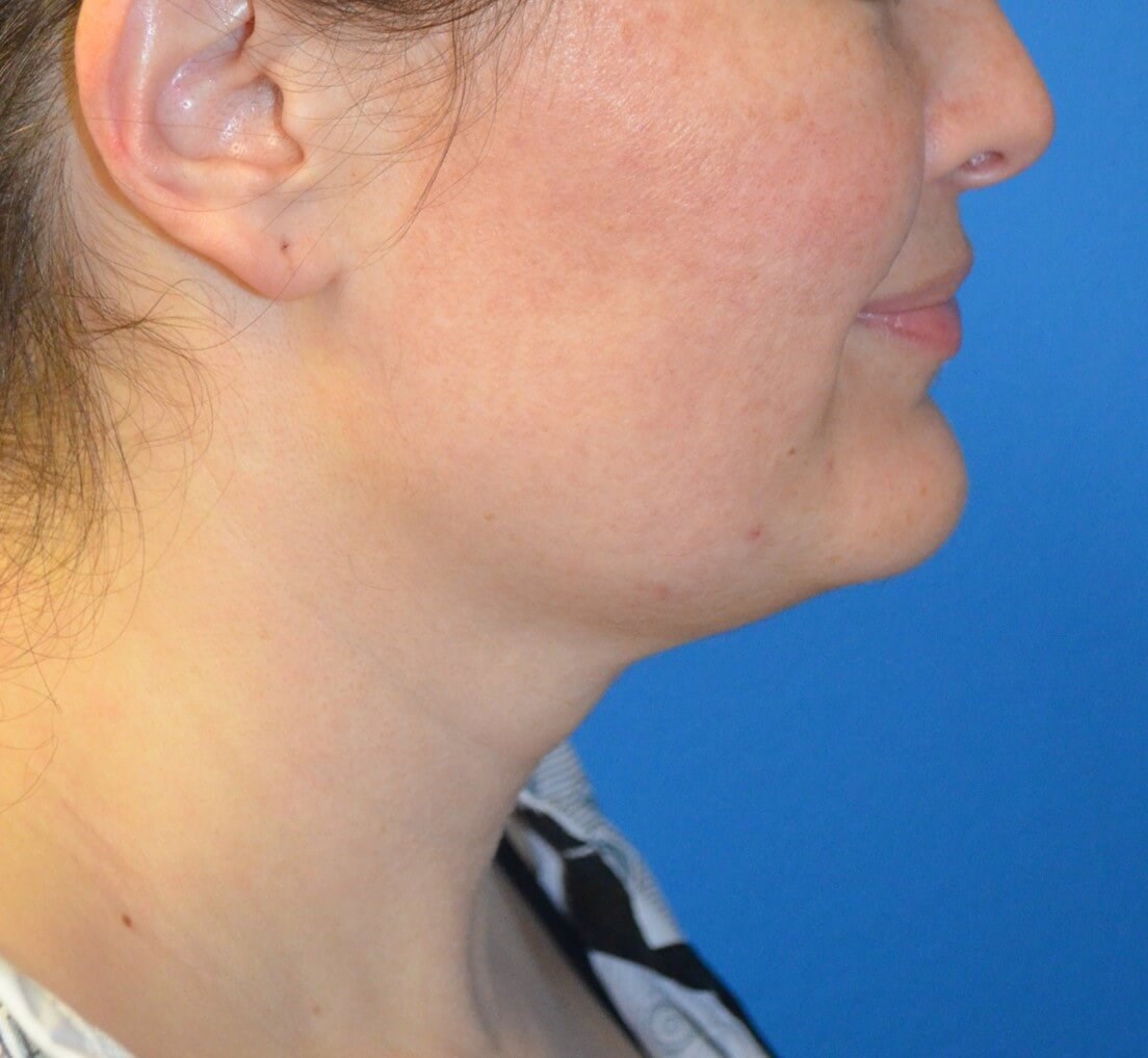 Deep Necklift (Submental) Before