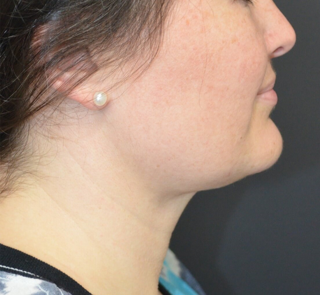 Deep Necklift (Submental) After