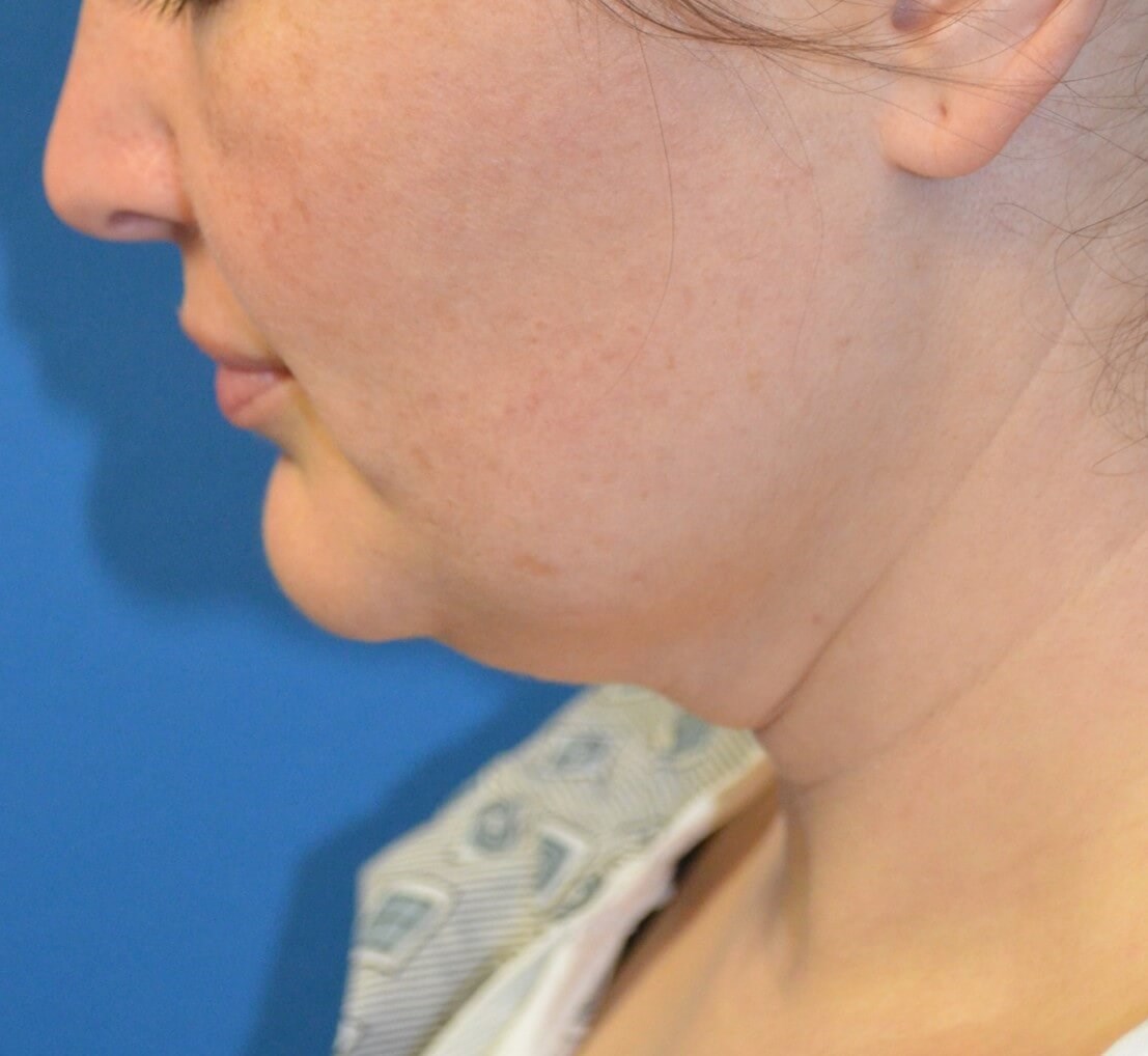 Deep Necklift (Submental) Before