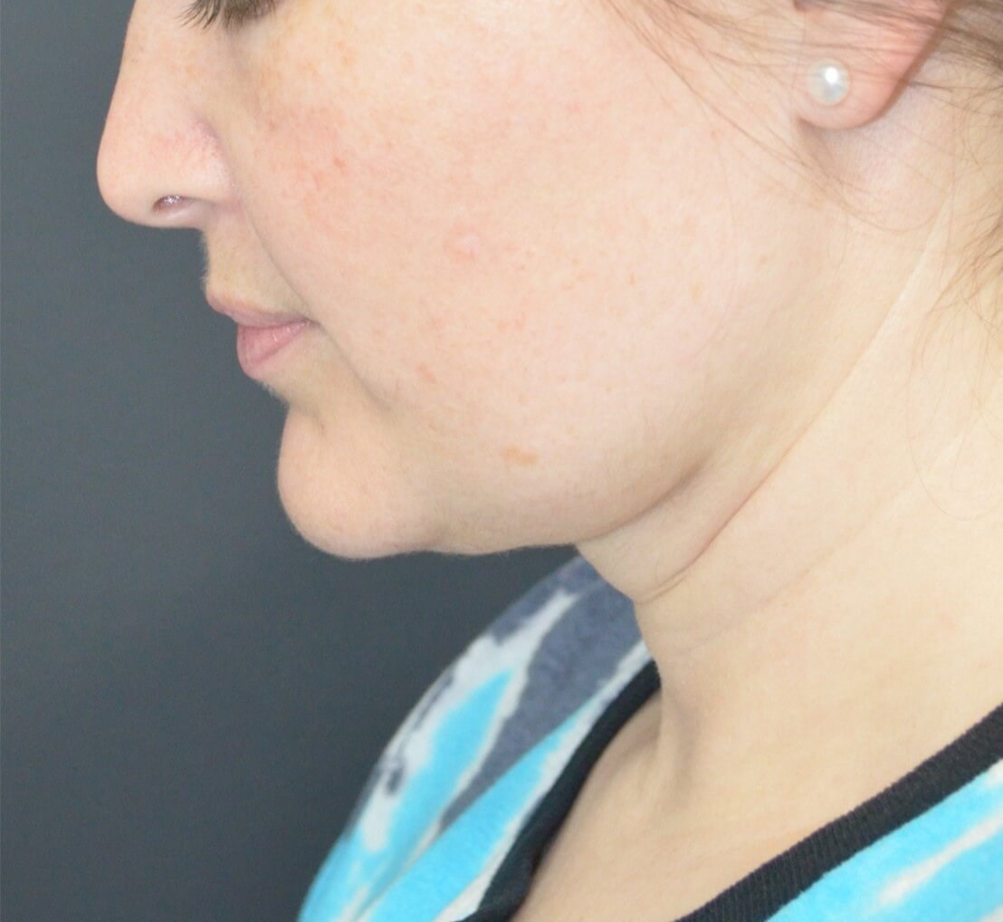 Deep Necklift (Submental) After