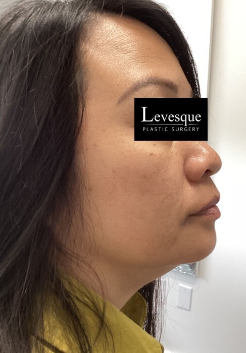 Lumecca (IPL) Face After