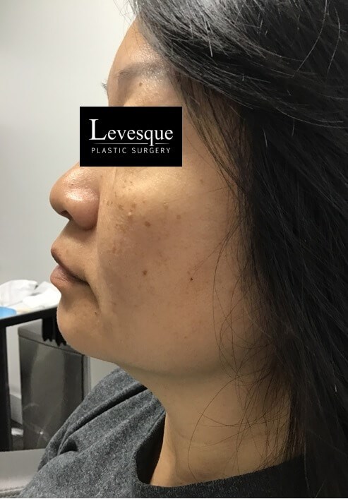 Lumecca (IPL) Face Before