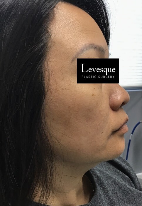 Lumecca (IPL) Face Before