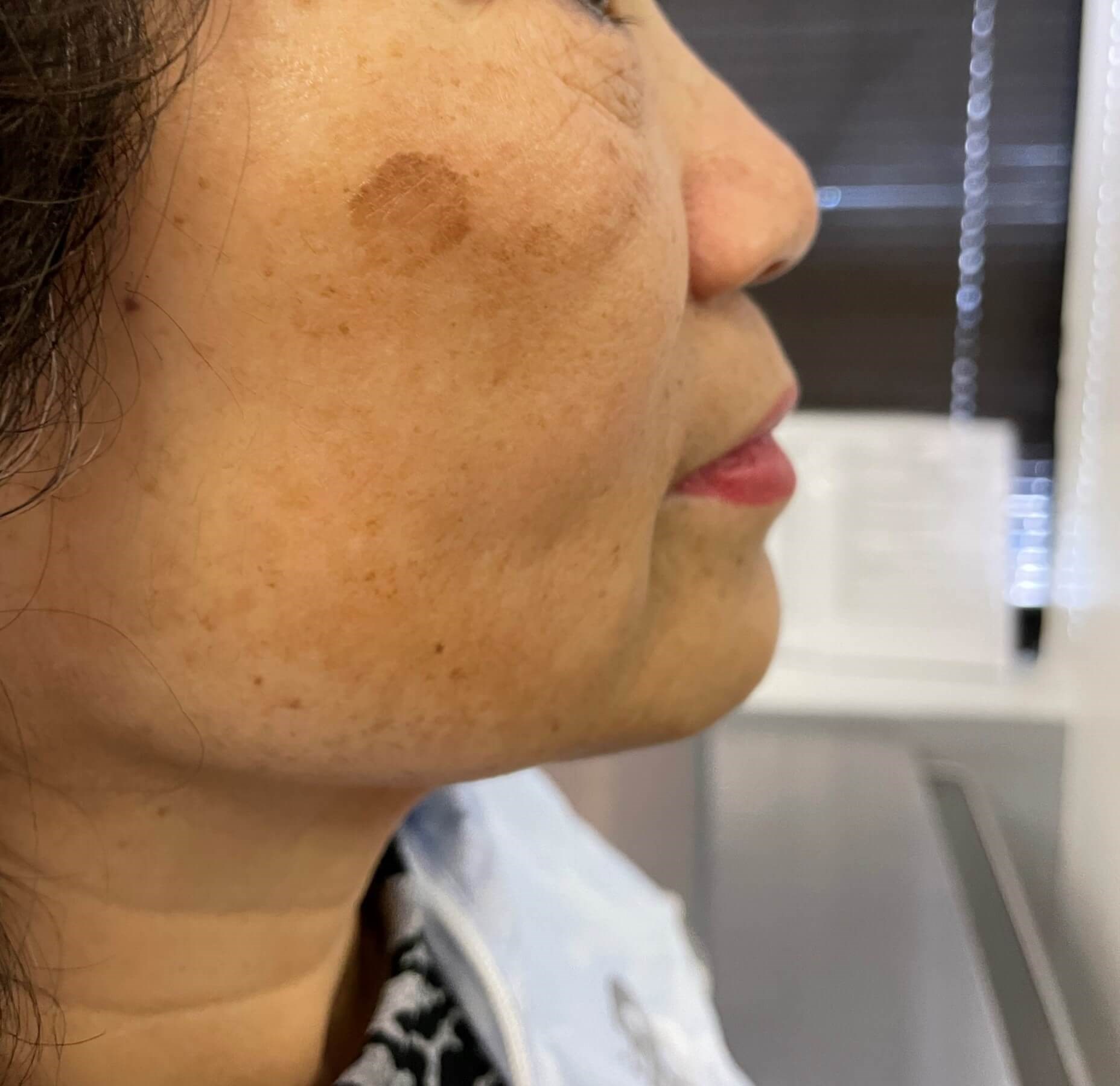 Lumecca (IPL) Face 1 treatment Before
