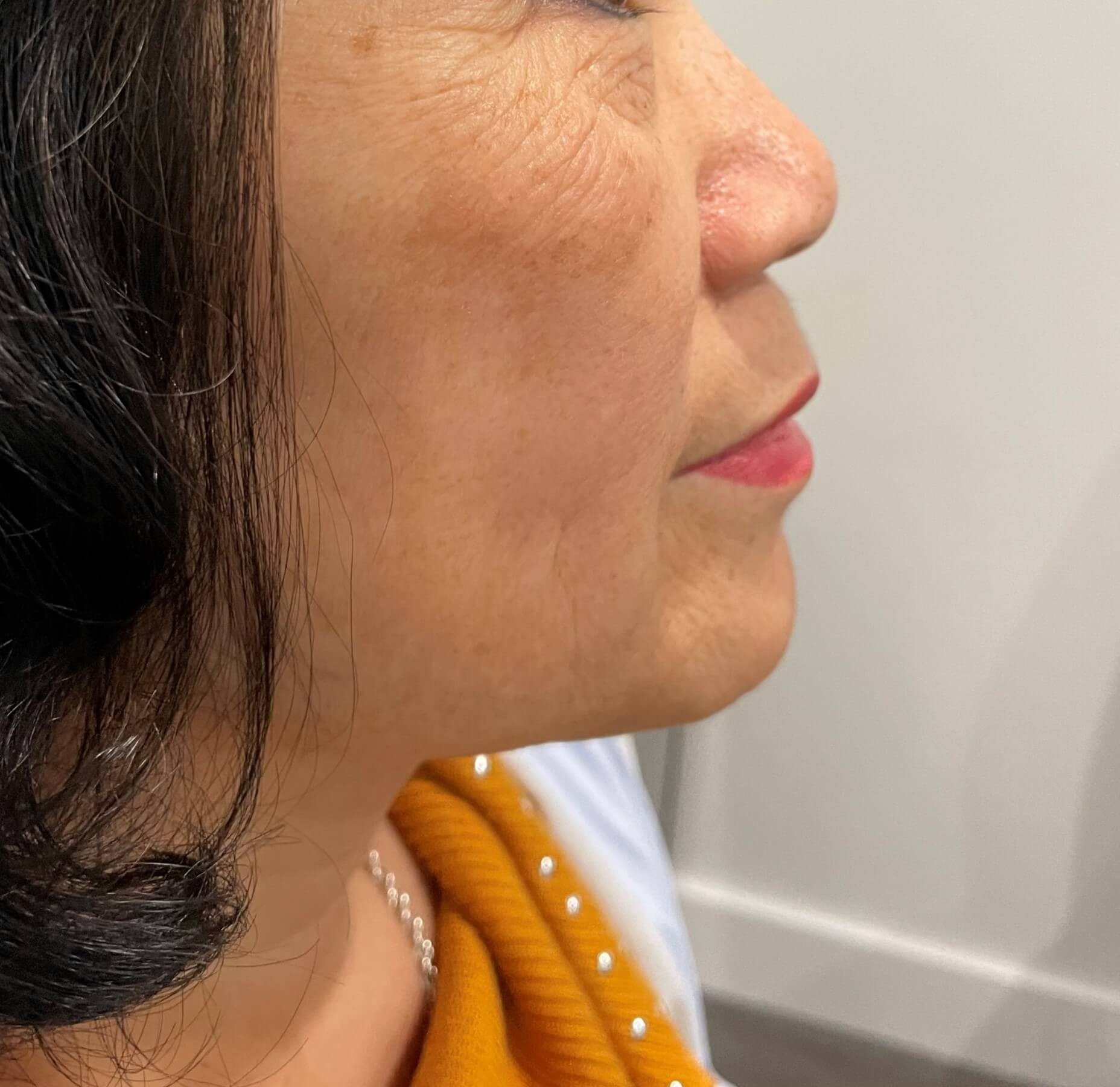 Lumecca (IPL) Face 1 treatment After