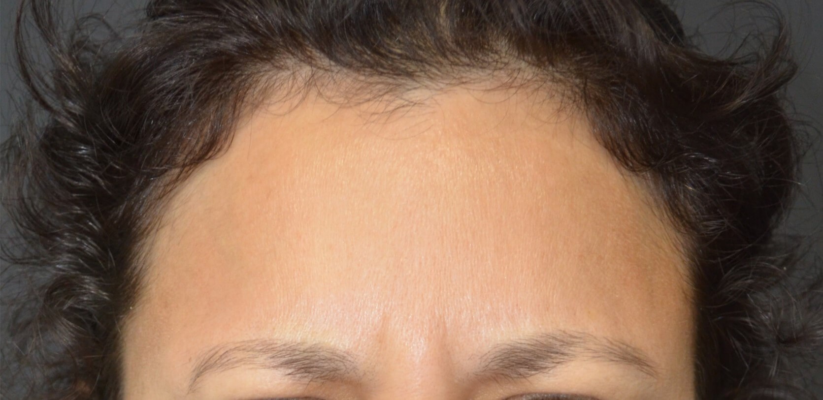 Botox forehead, crowsfeet After