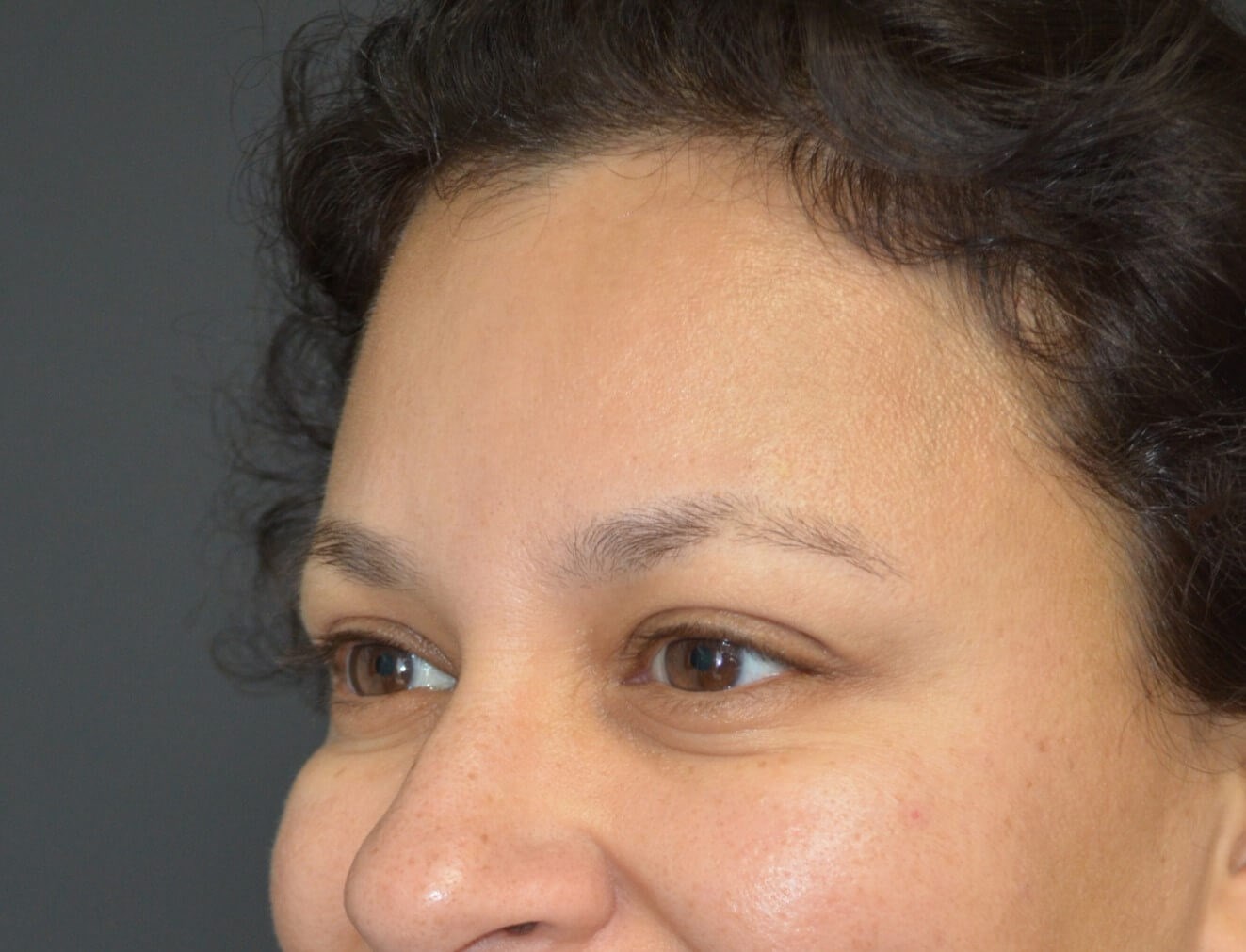 Botox forehead, crowsfeet After