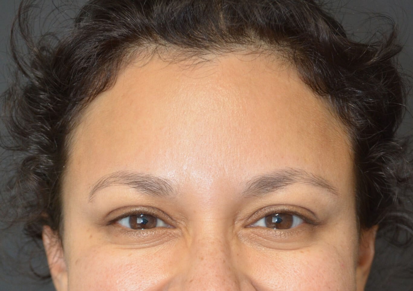 Botox forehead, crowsfeet After