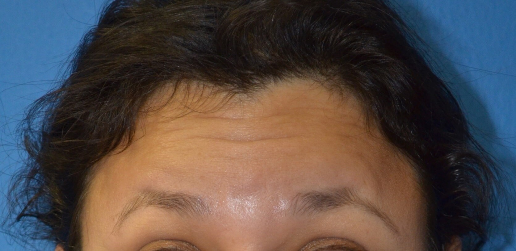 Botox forehead, crowsfeet Before