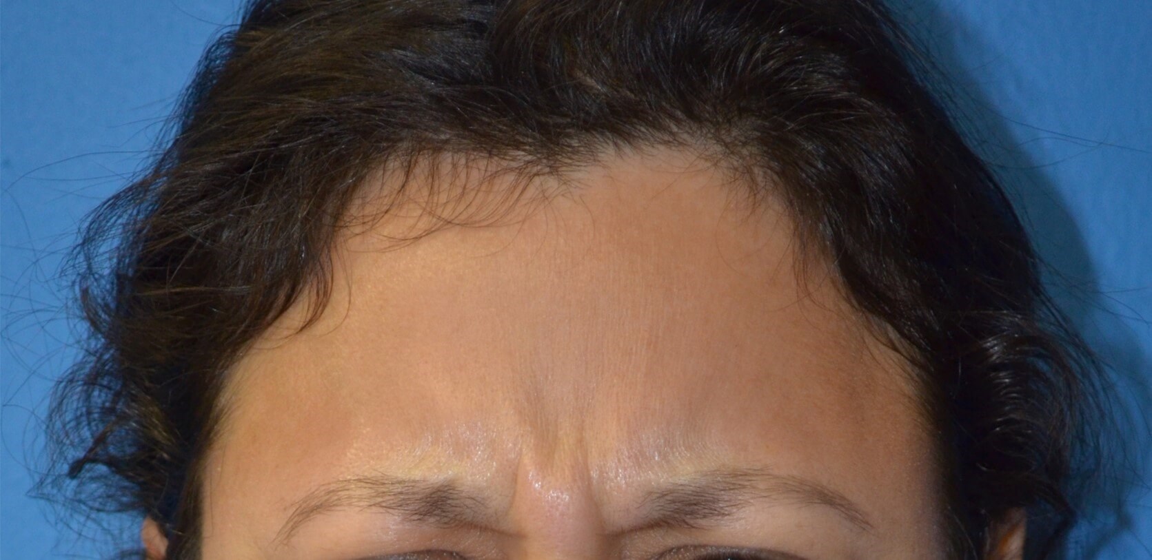 Botox forehead, crowsfeet Before