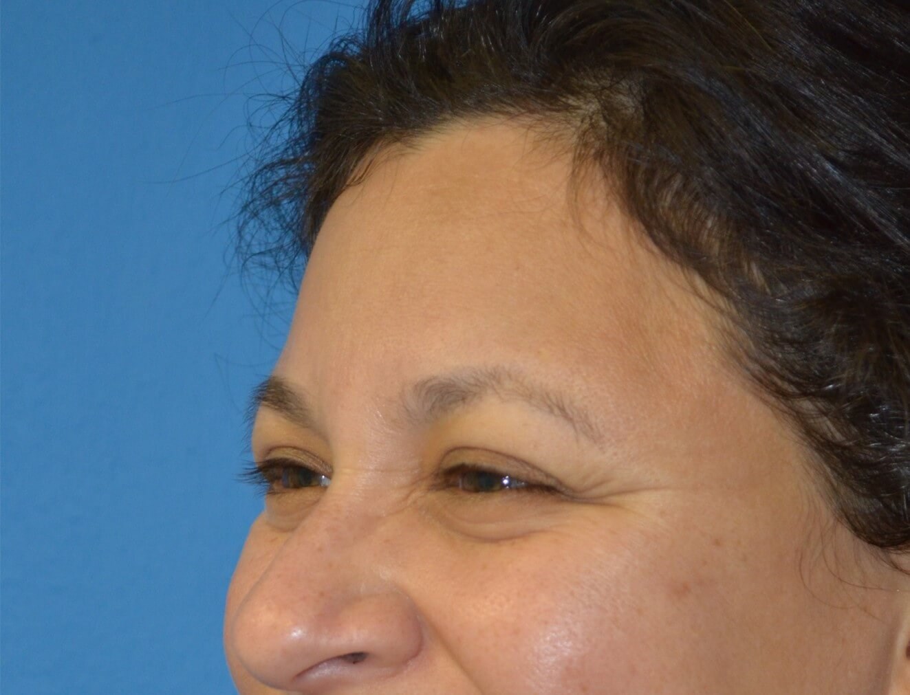 Botox forehead, crowsfeet Before