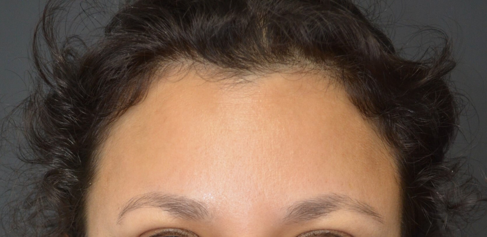 Botox forehead, crowsfeet After