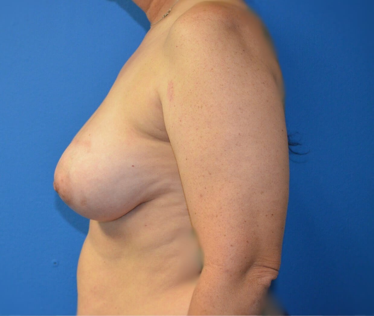 Breast augmentation 500 cc IMF After
