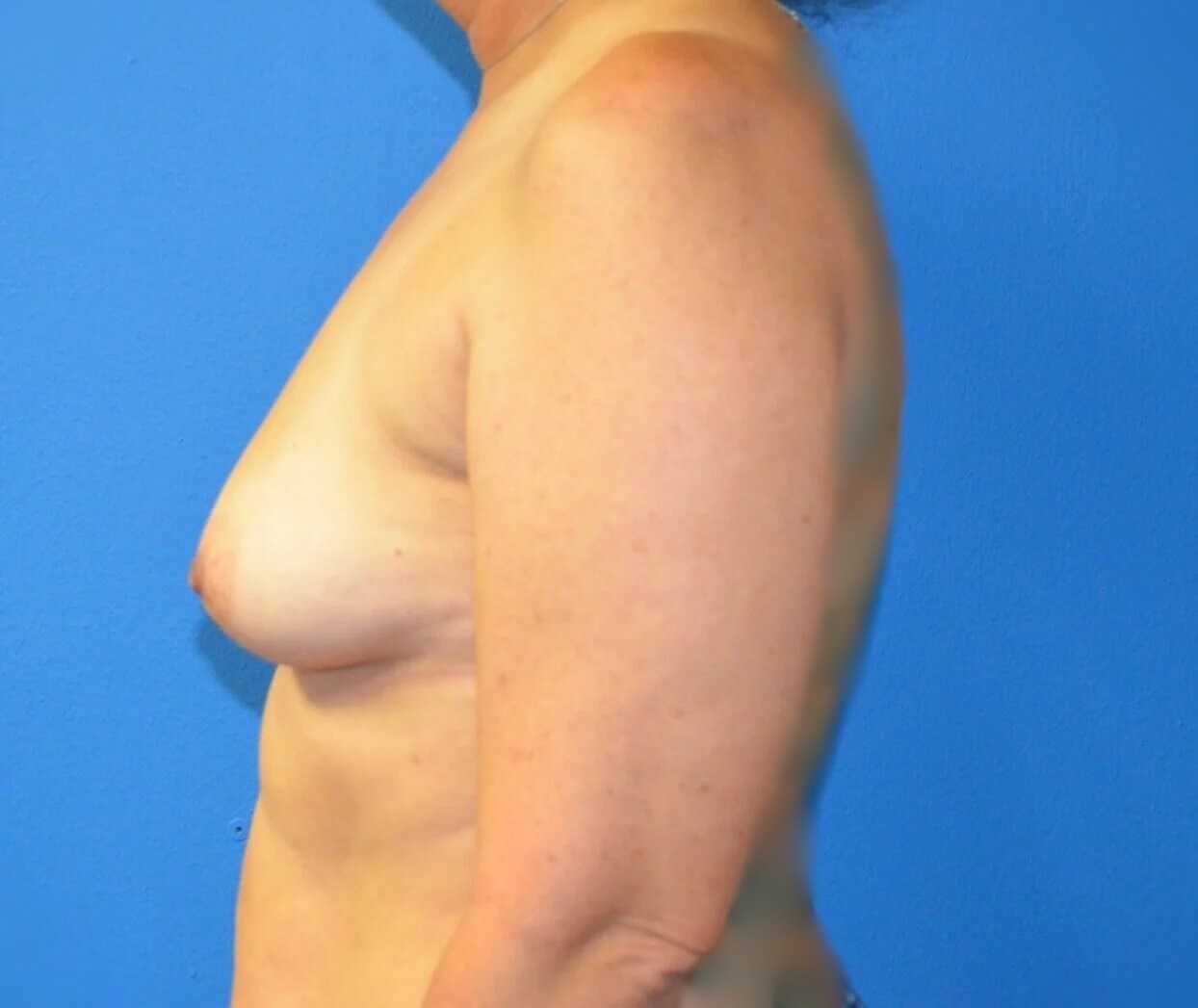 Breast augmentation 500 cc IMF Before