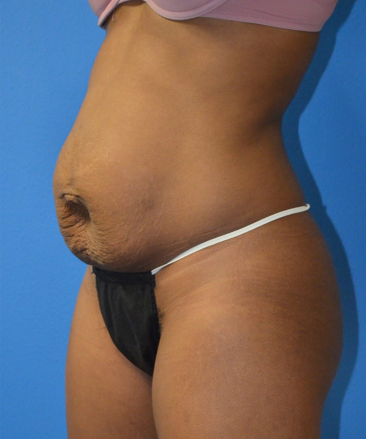 Lipoabdominoplasty Before