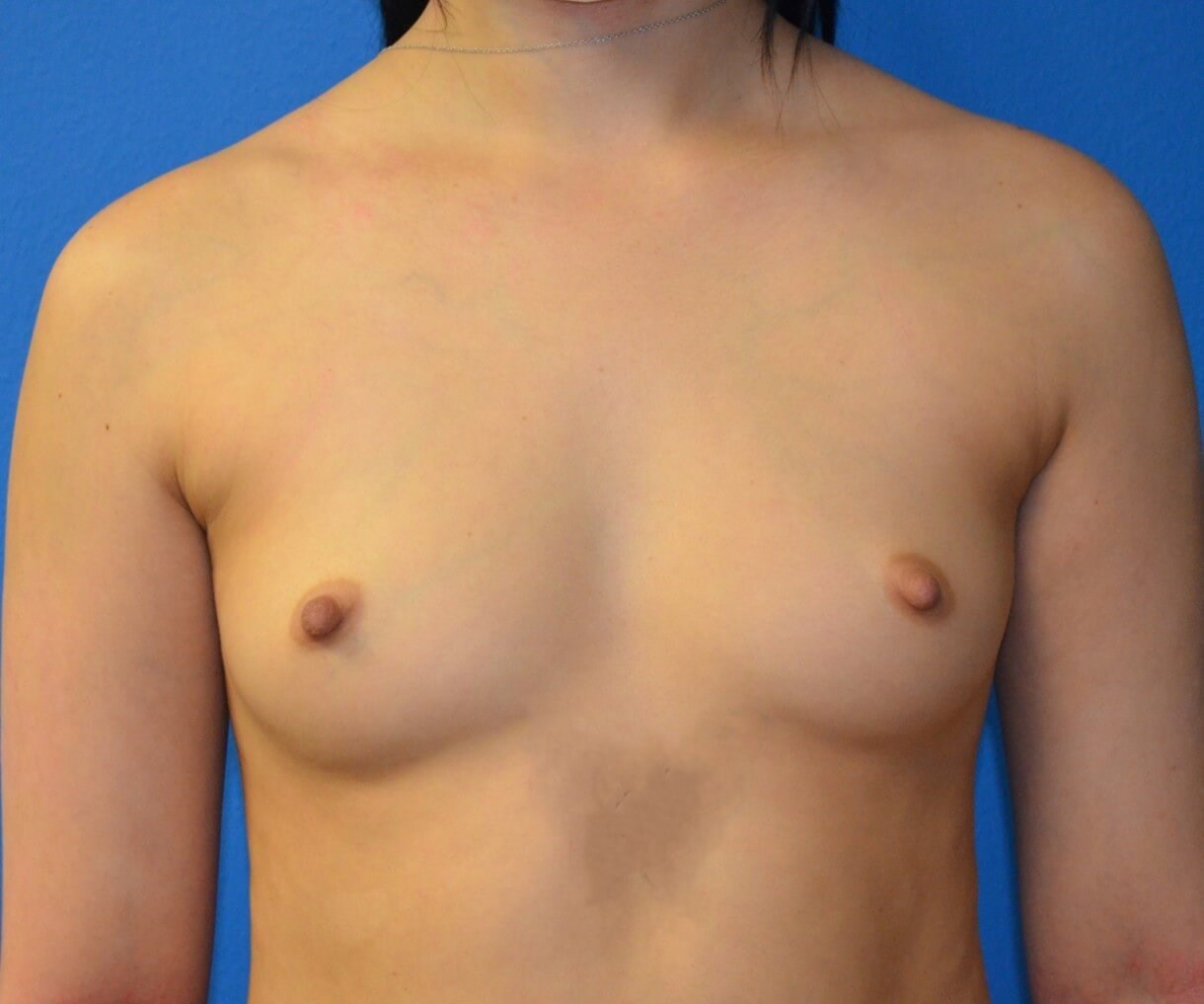 Breast Augmentation 350 cc mod Before