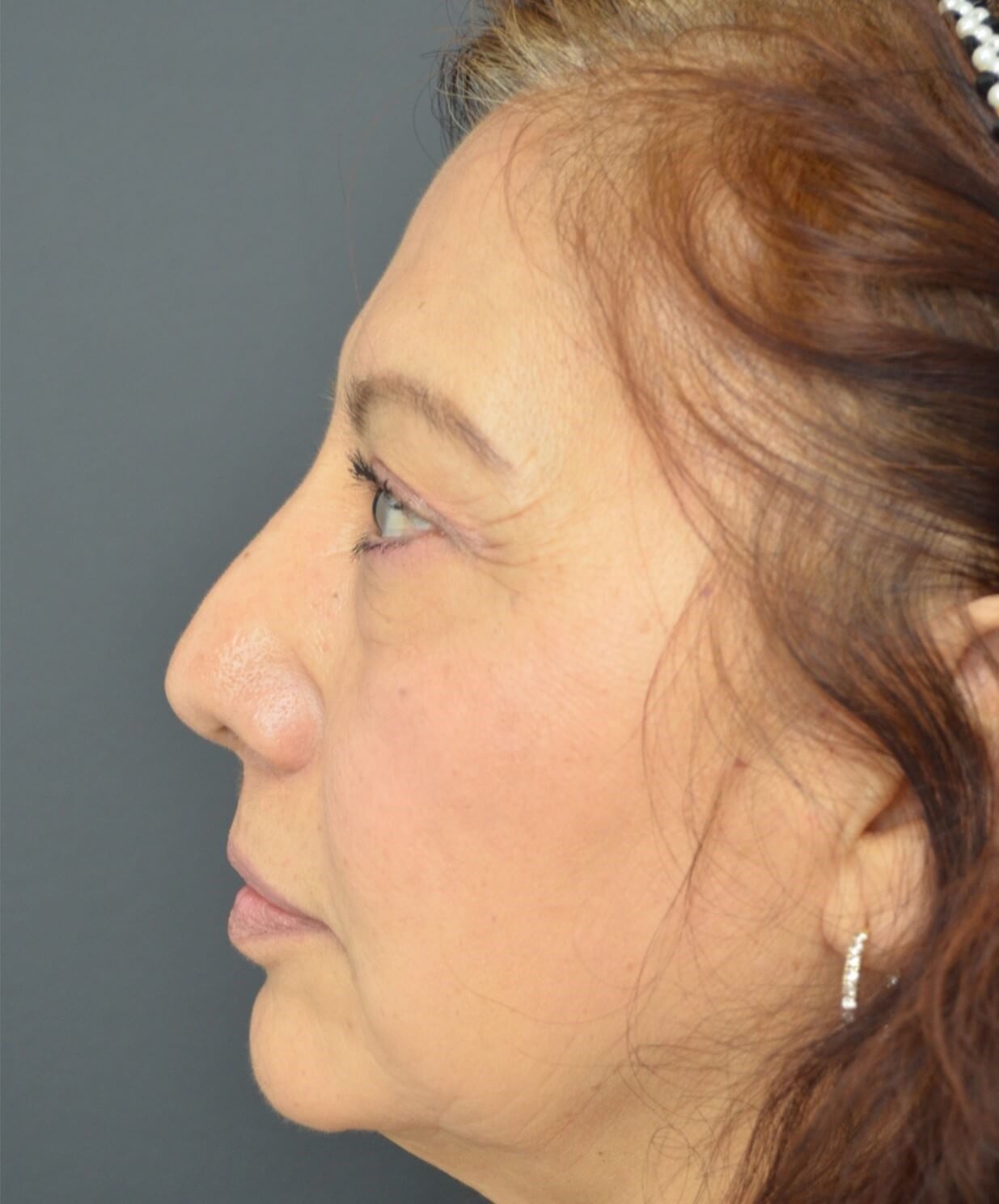 Upper Lid Lift and Ptosis After