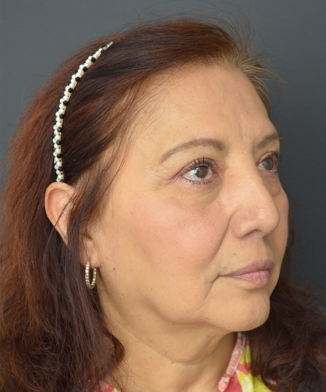 Upper Lid Lift and Ptosis After
