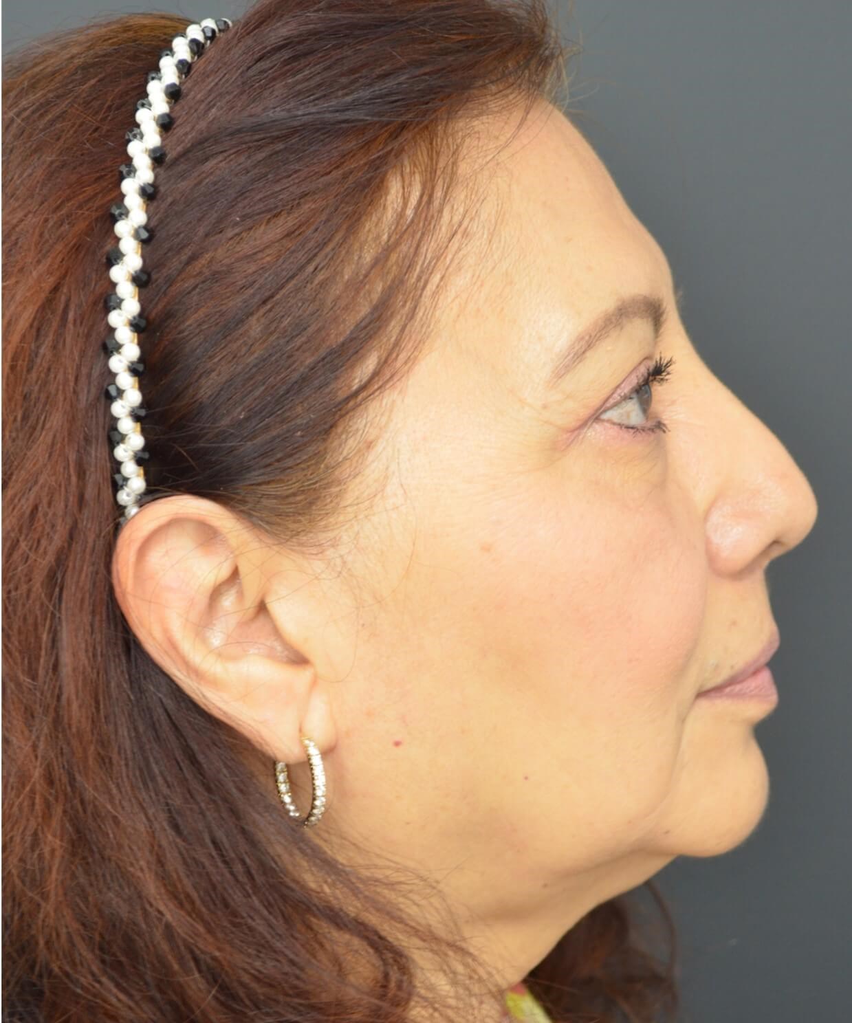 Upper Lid Lift and Ptosis After