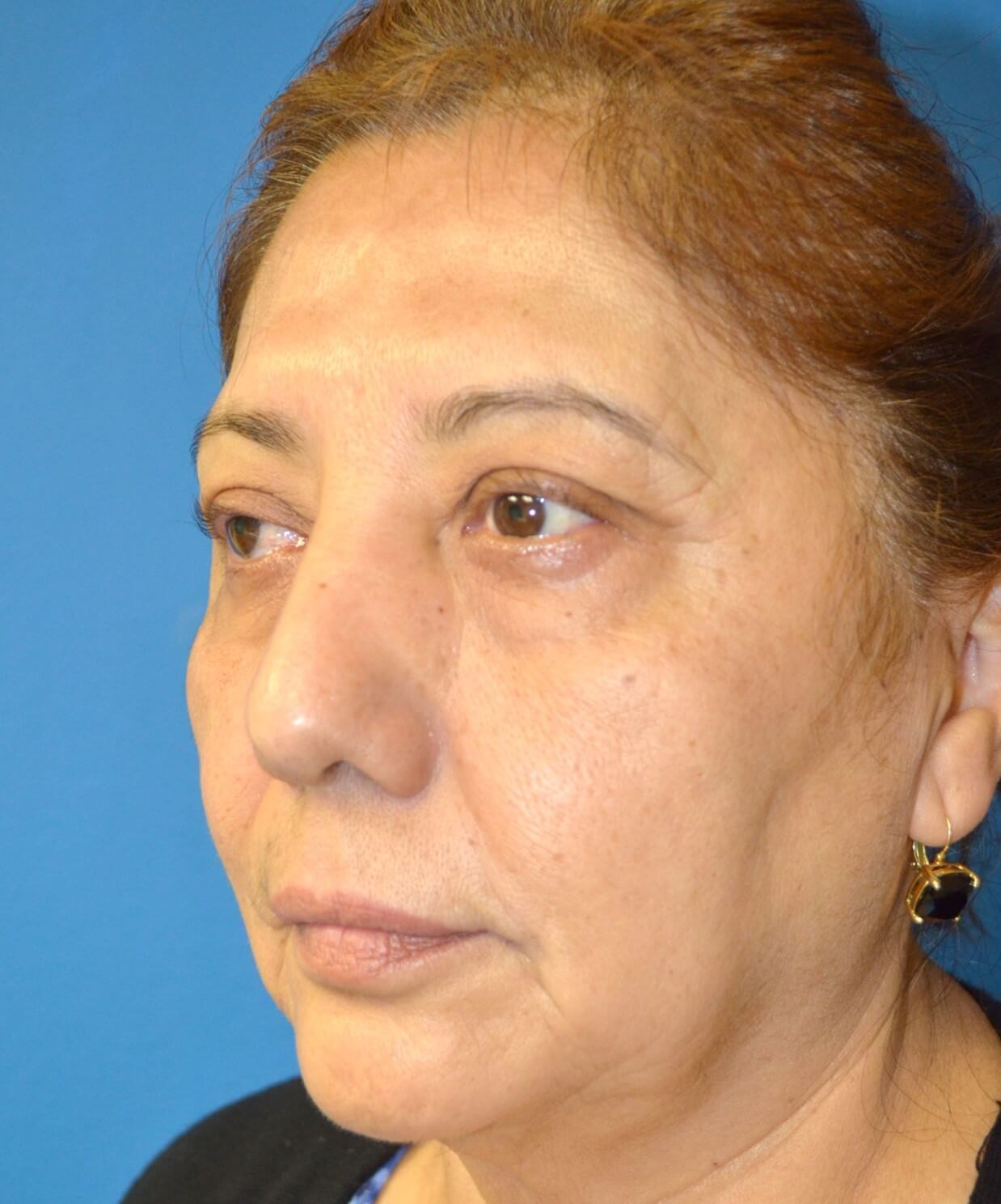Upper Lid Lift and Ptosis Before