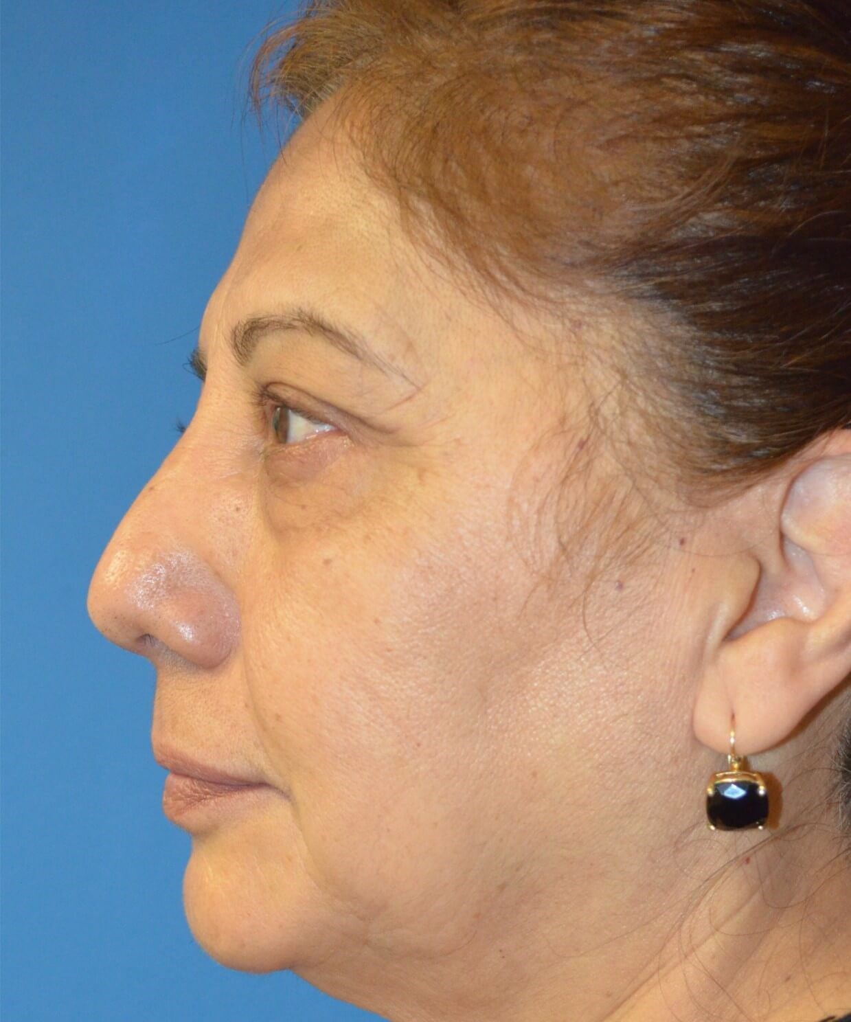 Upper Lid Lift and Ptosis Before