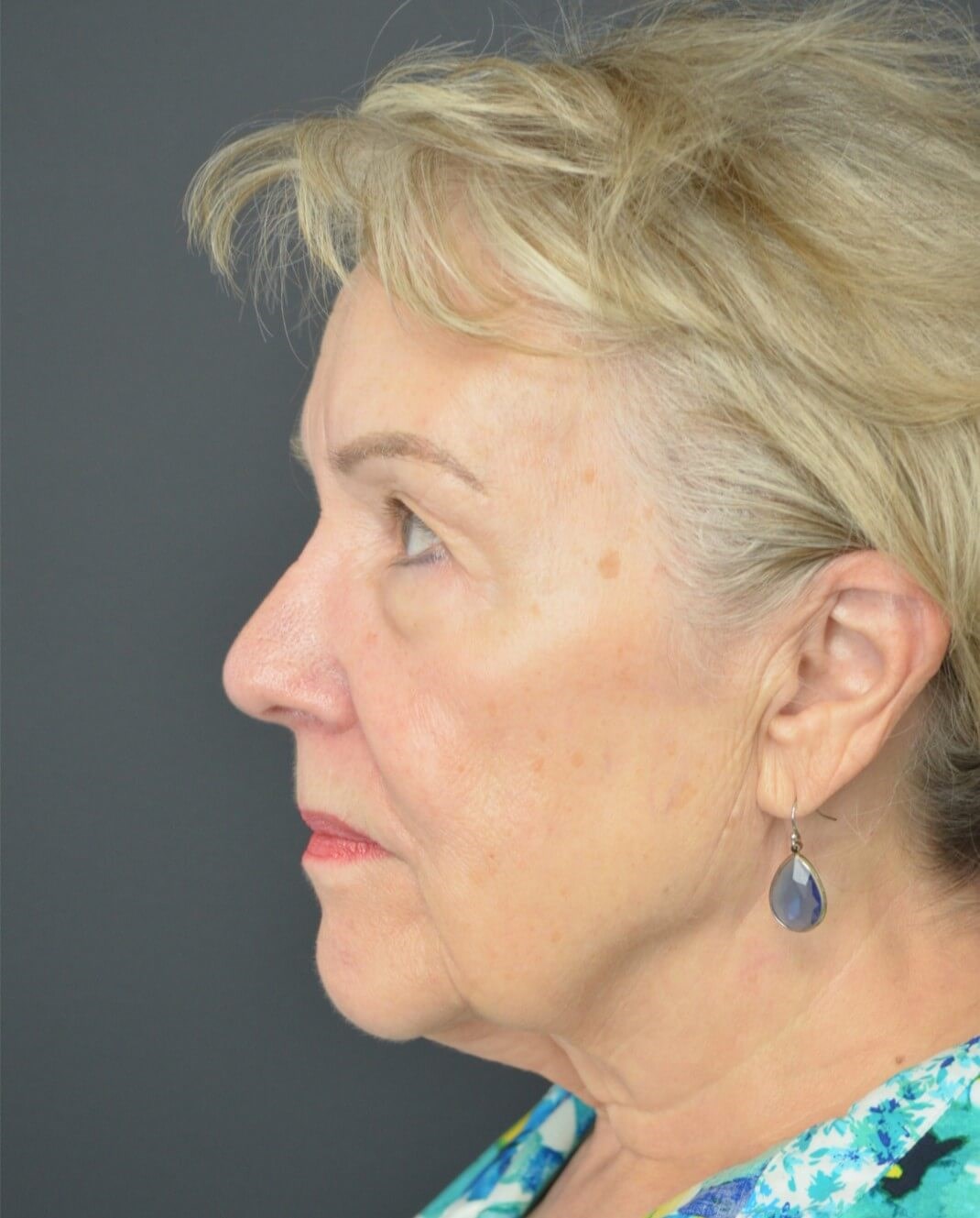 Deep plane face and necklift Before