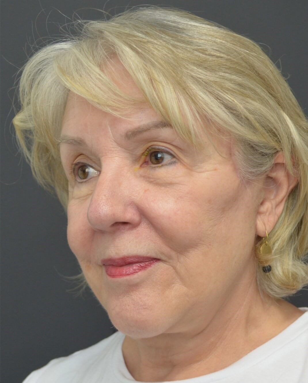 Deep plane face and necklift After