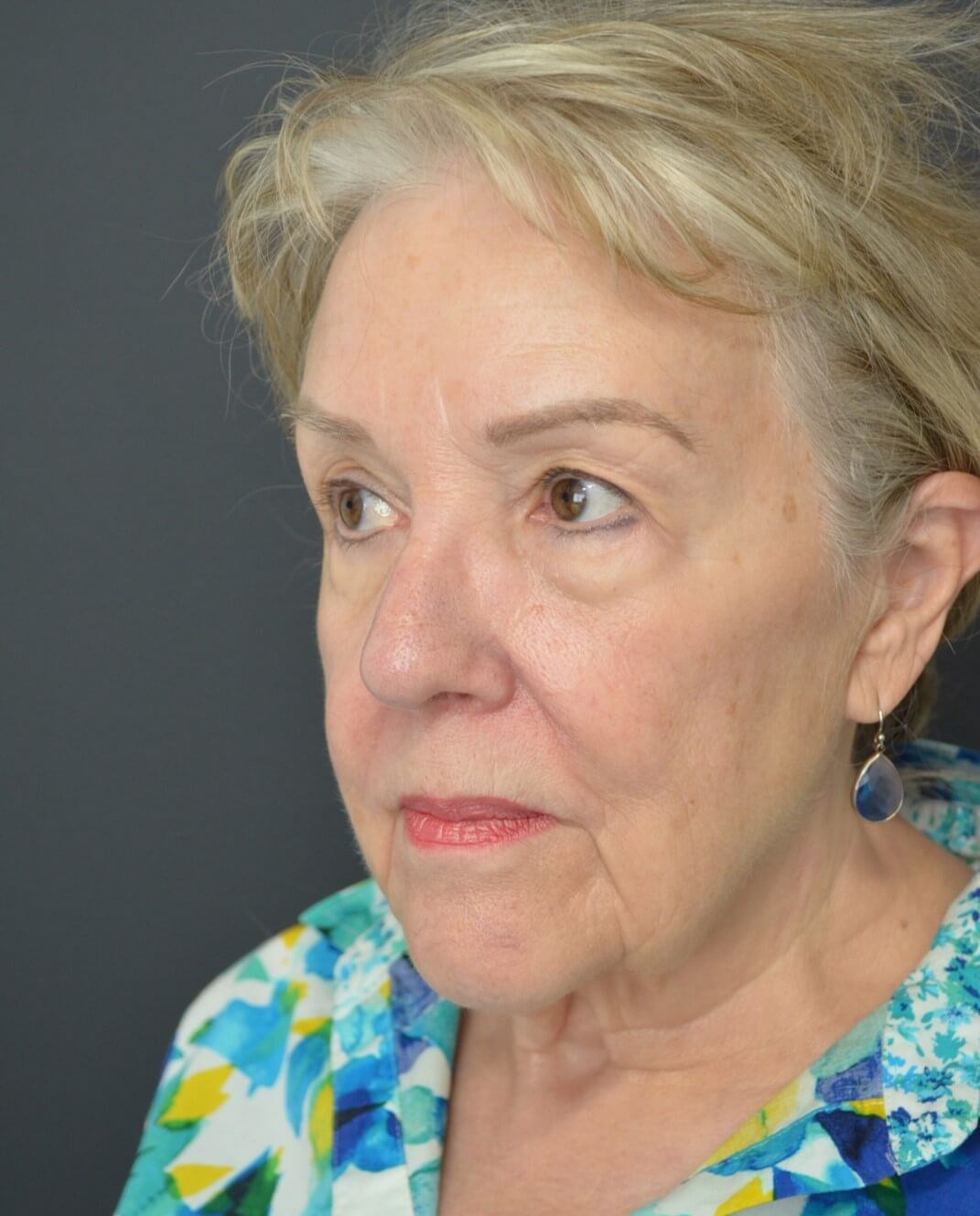 Deep plane face and necklift Before