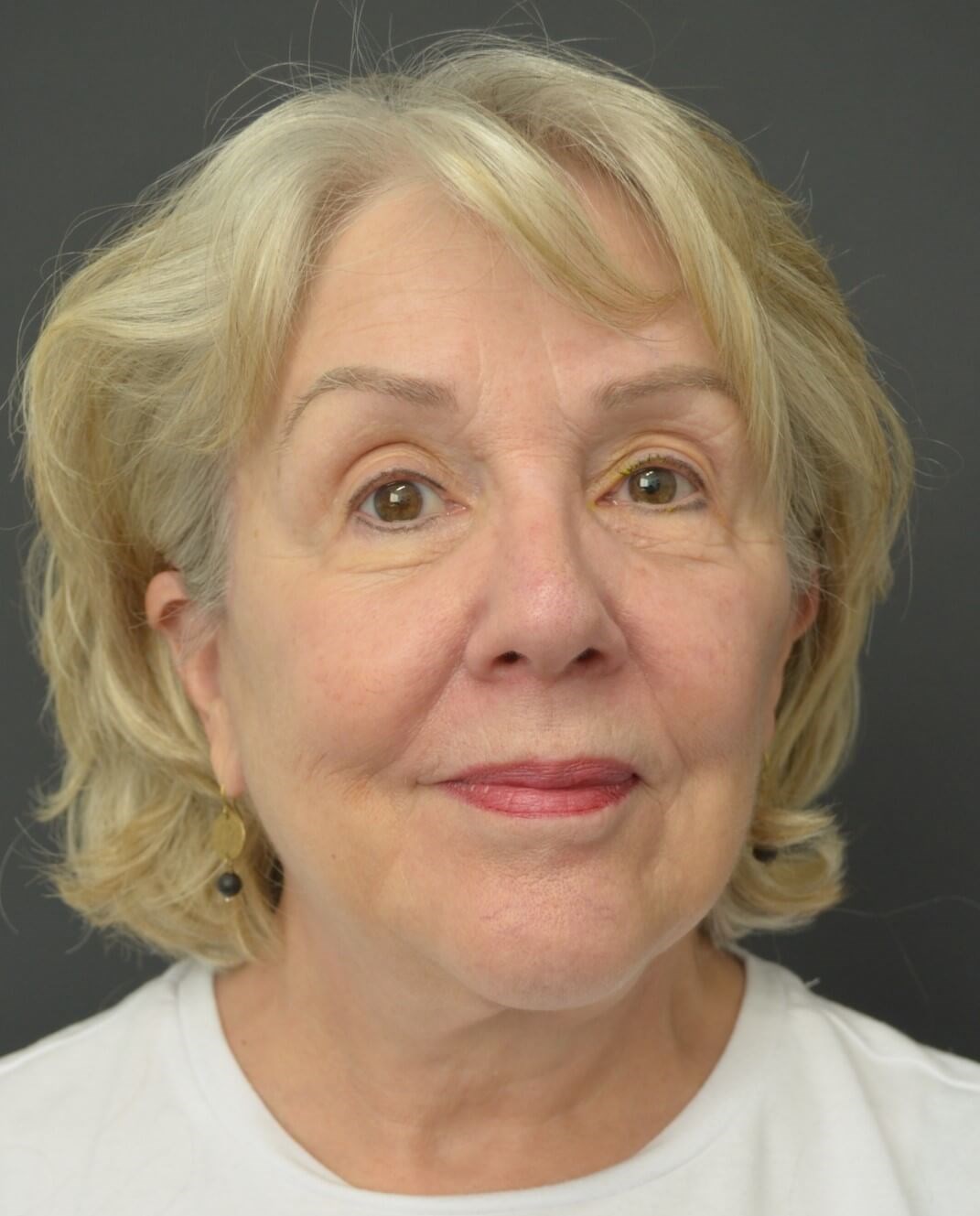 Deep plane face and necklift After